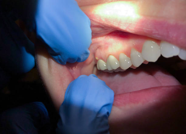 Best Emergency Dental Care for Broken or Chipped Teeth in Glenshaw, PA