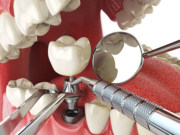 Best Emergency Denture Repair in Glenshaw, PA